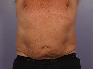 CoolSculpting Gallery Before & After Image