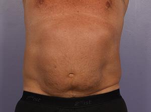 CoolSculpting Gallery Before & After Image