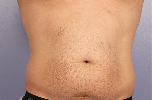 CoolSculpting Gallery Before & After Image