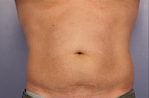 CoolSculpting Gallery Before & After Image