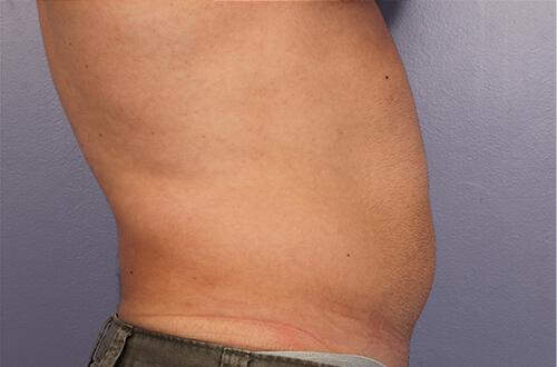 CoolSculpting Gallery Before & After Image