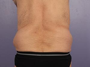 CoolSculpting Gallery Before & After Image