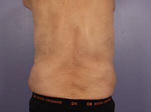 CoolSculpting Gallery Before & After Image