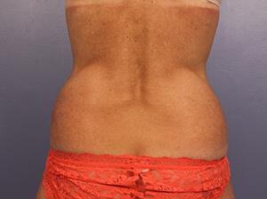 CoolSculpting Gallery Before & After Image