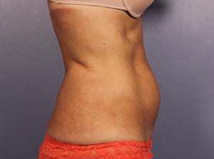 CoolSculpting Gallery Before & After Image