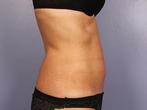 CoolSculpting Gallery Before & After Image