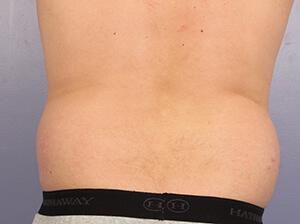 CoolSculpting Gallery Before & After Image