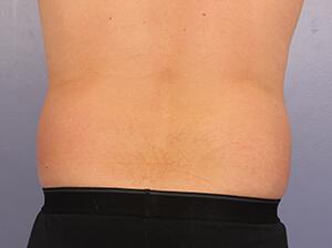 CoolSculpting Gallery Before & After Image