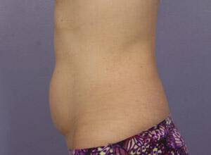 CoolSculpting Gallery Before & After Image