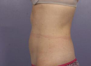 CoolSculpting Gallery Before & After Image