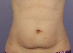 CoolSculpting Gallery Before & After Image