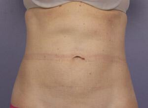 CoolSculpting Gallery Before & After Image