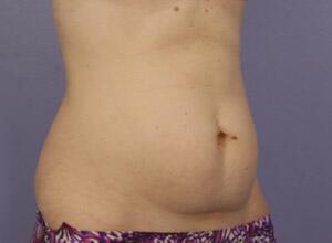 CoolSculpting Gallery Before & After Image