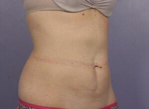 CoolSculpting Gallery Before & After Image