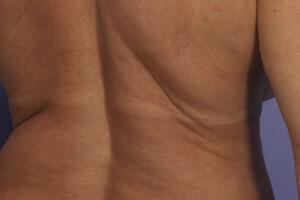 CoolSculpting Gallery Before & After Image