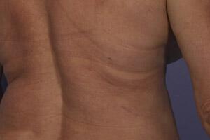 CoolSculpting Gallery Before & After Image