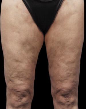 CoolSculpting Gallery Before & After Image