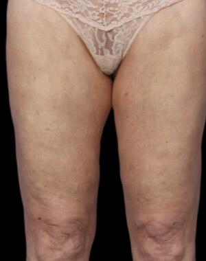 CoolSculpting Gallery Before & After Image