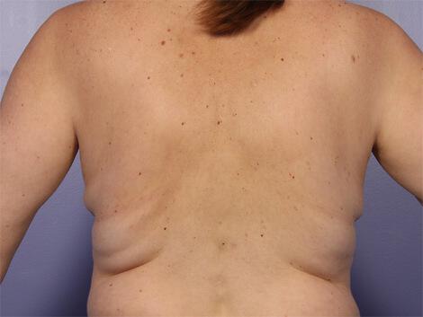 CoolSculpting Gallery Before & After Image