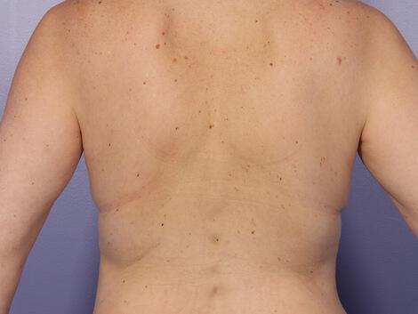 CoolSculpting Gallery Before & After Image