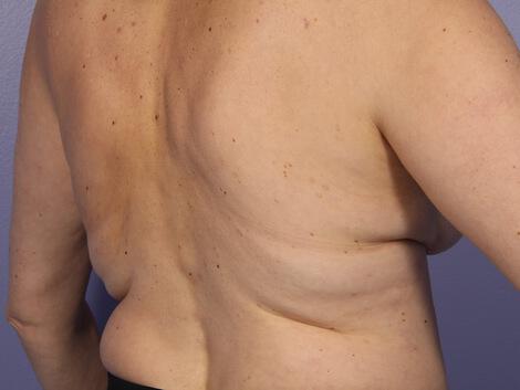 CoolSculpting Gallery Before & After Image