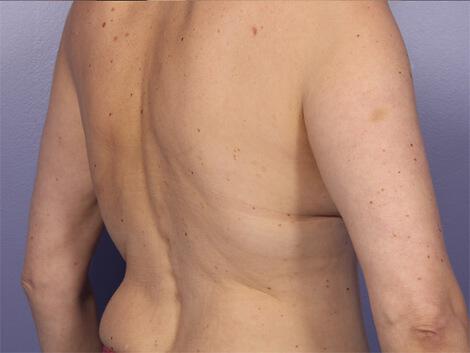 CoolSculpting Gallery Before & After Image