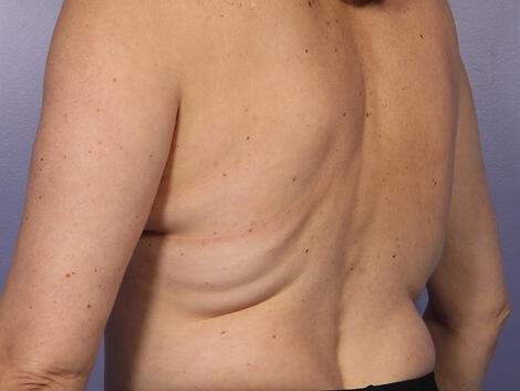 CoolSculpting Gallery Before & After Image