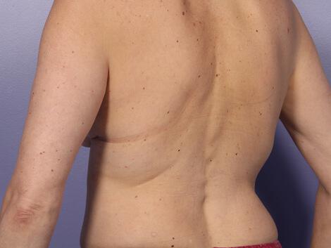 CoolSculpting Gallery Before & After Image