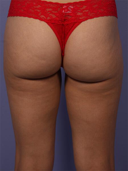 CoolSculpting Gallery Before & After Image