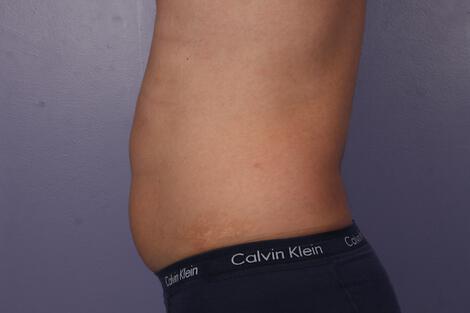 CoolSculpting Gallery Before & After Image