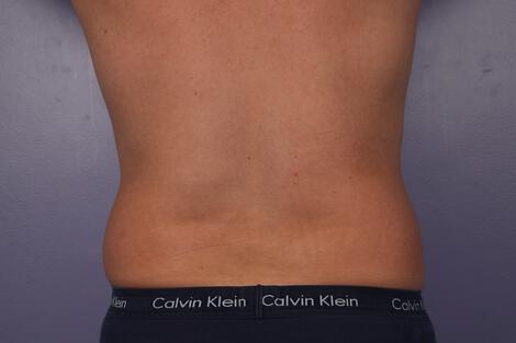 CoolSculpting Gallery Before & After Image