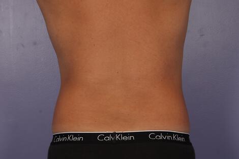 CoolSculpting Gallery Before & After Image