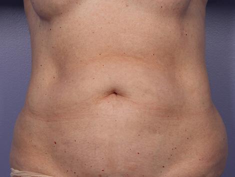 CoolSculpting Gallery Before & After Image