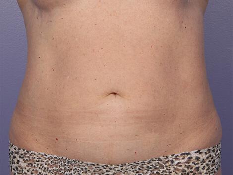 CoolSculpting Gallery Before & After Image