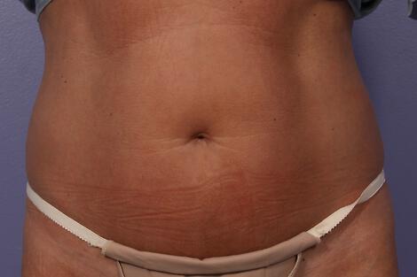 CoolSculpting Gallery Before & After Image