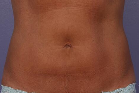 CoolSculpting Gallery Before & After Image