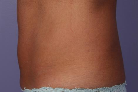 CoolSculpting Gallery Before & After Image