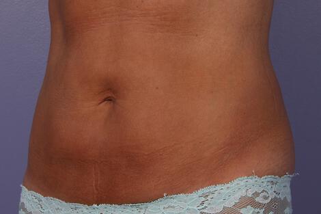 CoolSculpting Gallery Before & After Image