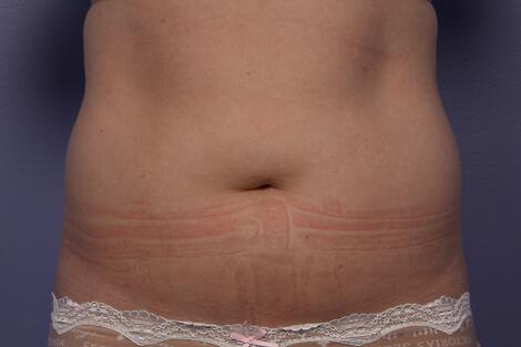 CoolSculpting Gallery Before & After Image
