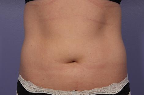 CoolSculpting Gallery Before & After Image