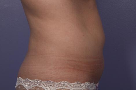 CoolSculpting Gallery Before & After Image