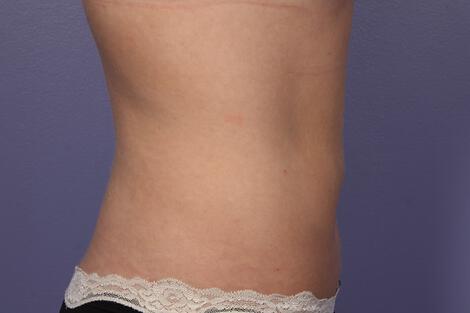 CoolSculpting Gallery Before & After Image