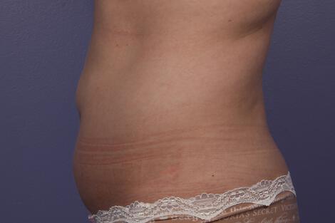 CoolSculpting Gallery Before & After Image