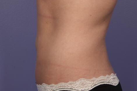 CoolSculpting Gallery Before & After Image