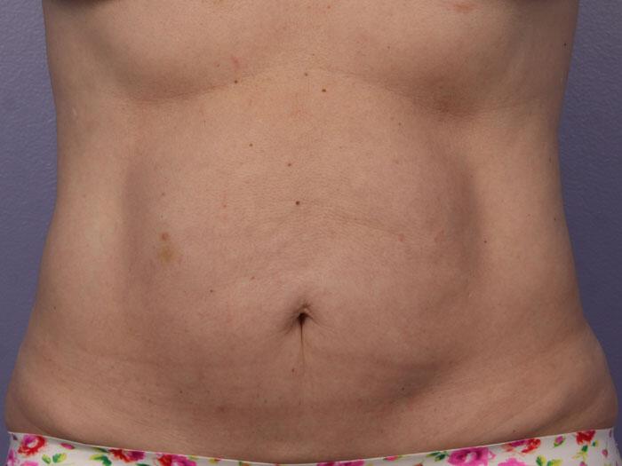 CoolSculpting Gallery Before & After Image