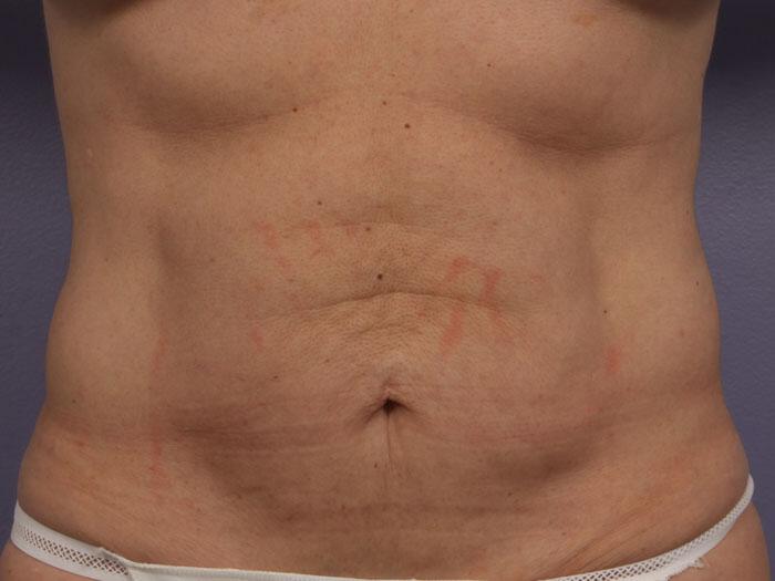 CoolSculpting Gallery Before & After Image