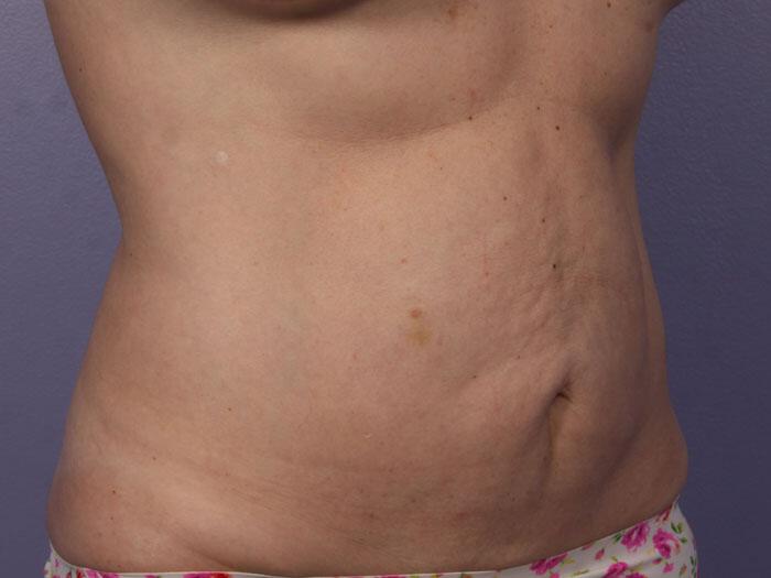 CoolSculpting Gallery Before & After Image