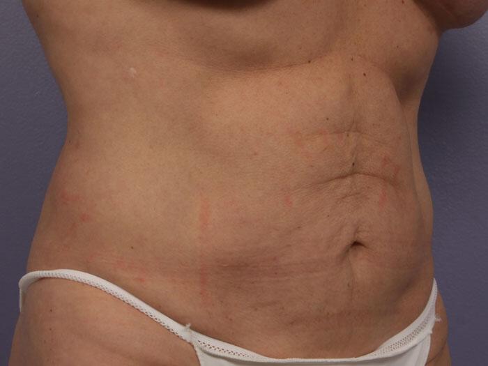 CoolSculpting Gallery Before & After Image