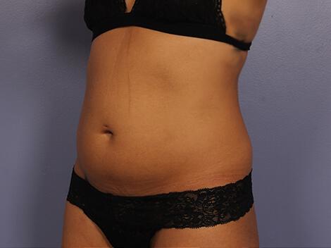 CoolSculpting Gallery Before & After Image