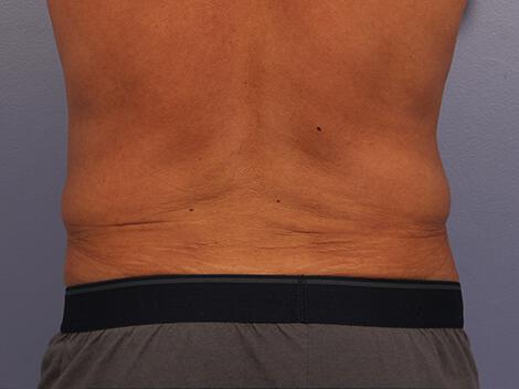 CoolSculpting Gallery Before & After Image